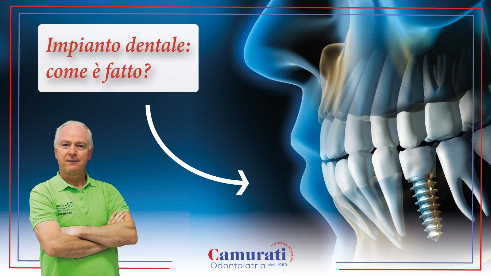 impianto dentale