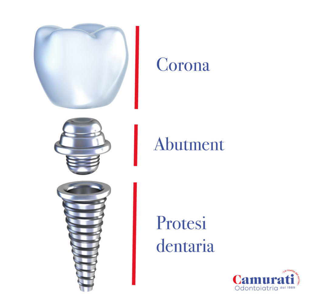 impianto dentale