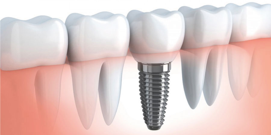 impianto dentale